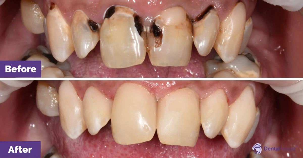 PJ’s Composite Veneers Journey in Sunbury Gallery image