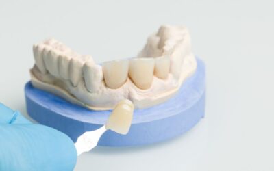How Long Do Porcelain Veneers Last? A Realistic Guide to Veneer Lifespan