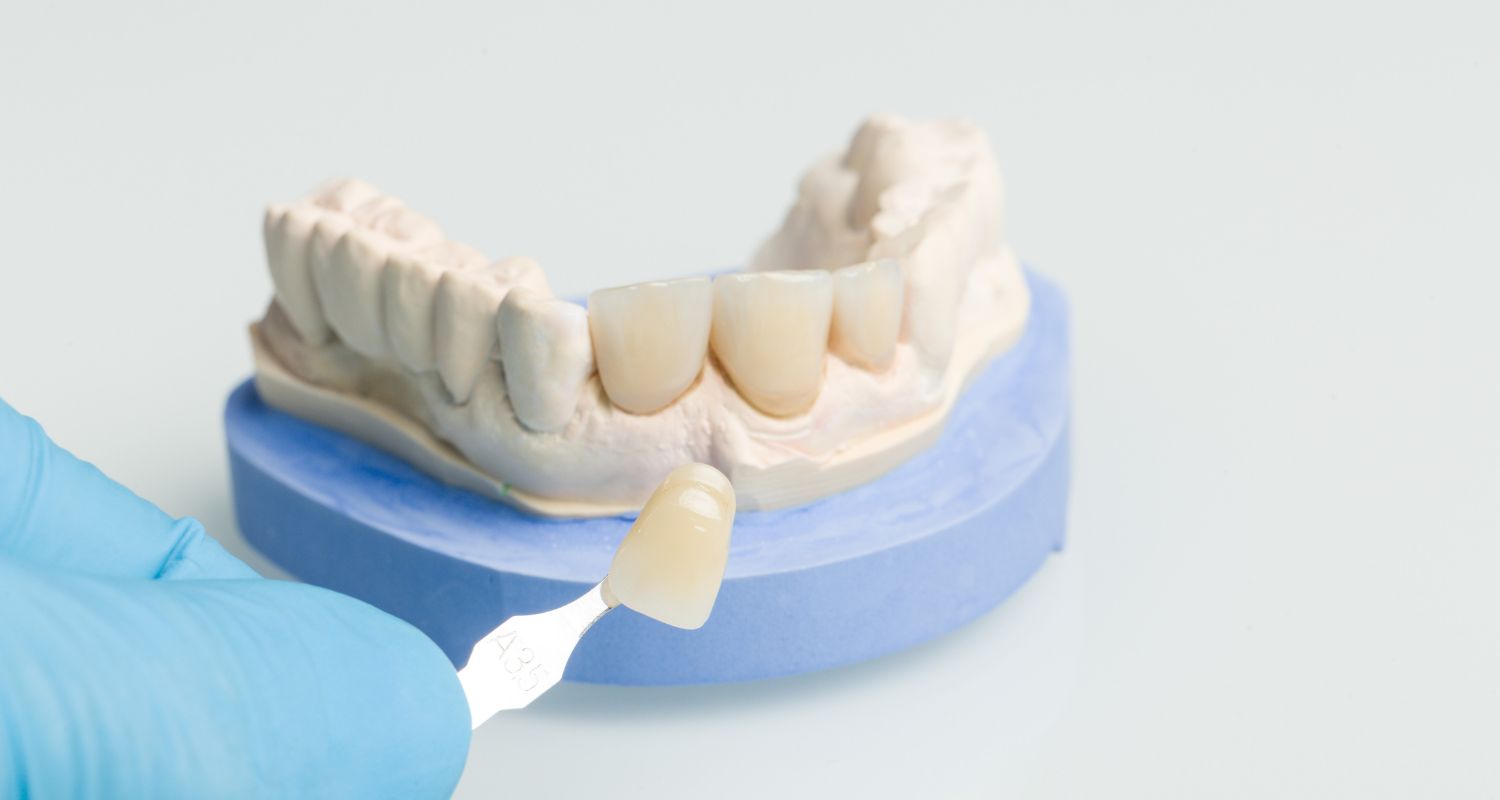 How Long Do Porcelain Veneers Last A Realistic Guide to Veneer Lifespan in Melton Dental House How Long Do Porcelain Veneers Last A Realistic Guide to Veneer Lifespan in Melton Dental House