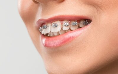 Why Do Teeth Shift After Braces? Understanding Orthodontic Relapse