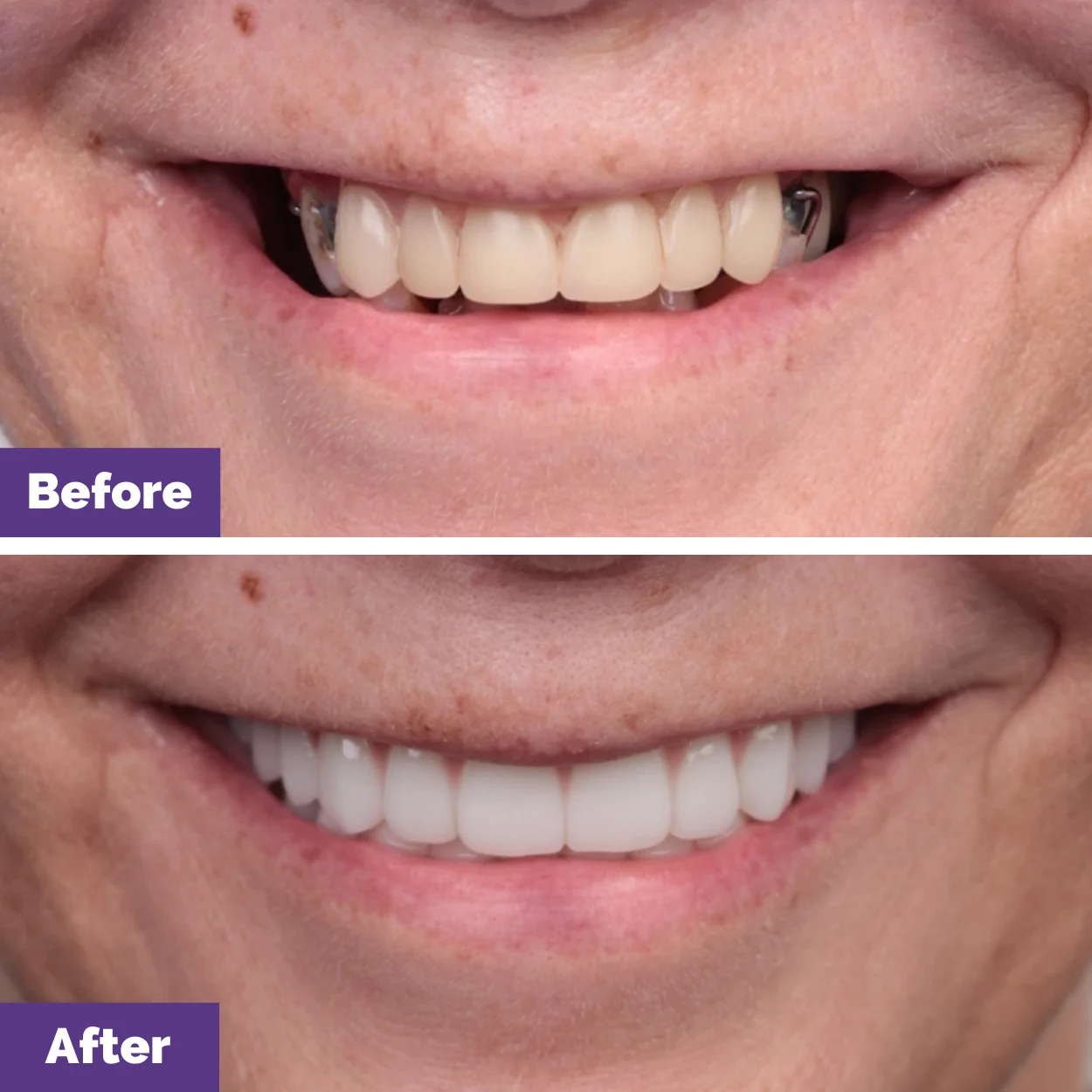 Jacky's All-on-4 Plus Journey in_Dental House