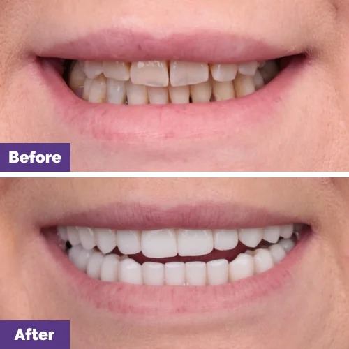 Kath's Upper and Lower All-On-4 Plus Smile Makeover in Dental House
