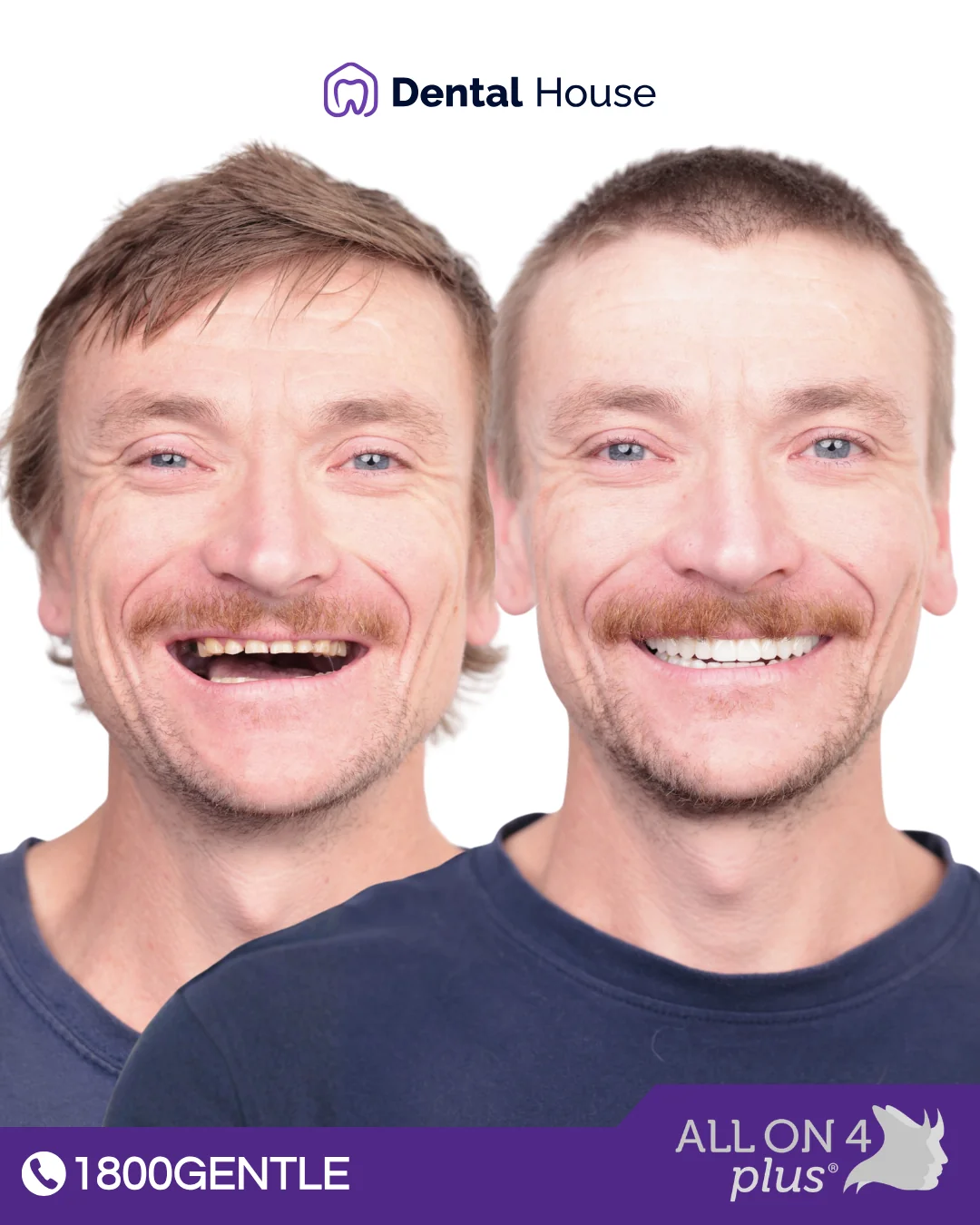 All-On-4 Plus®