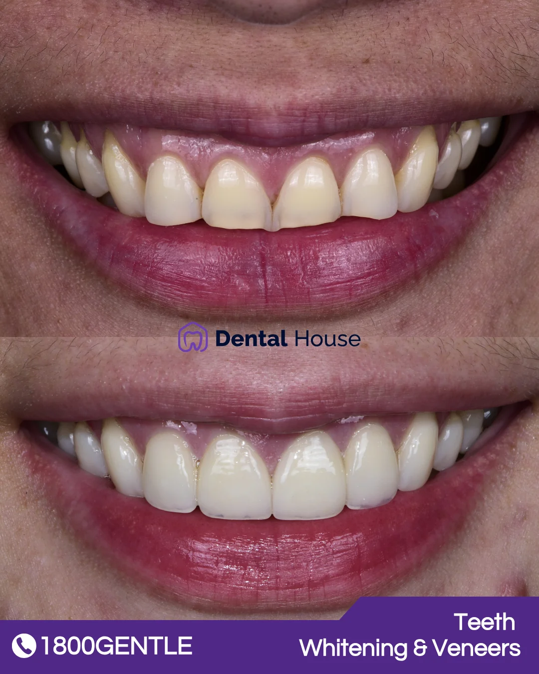 Teeth Whitening & Veneers