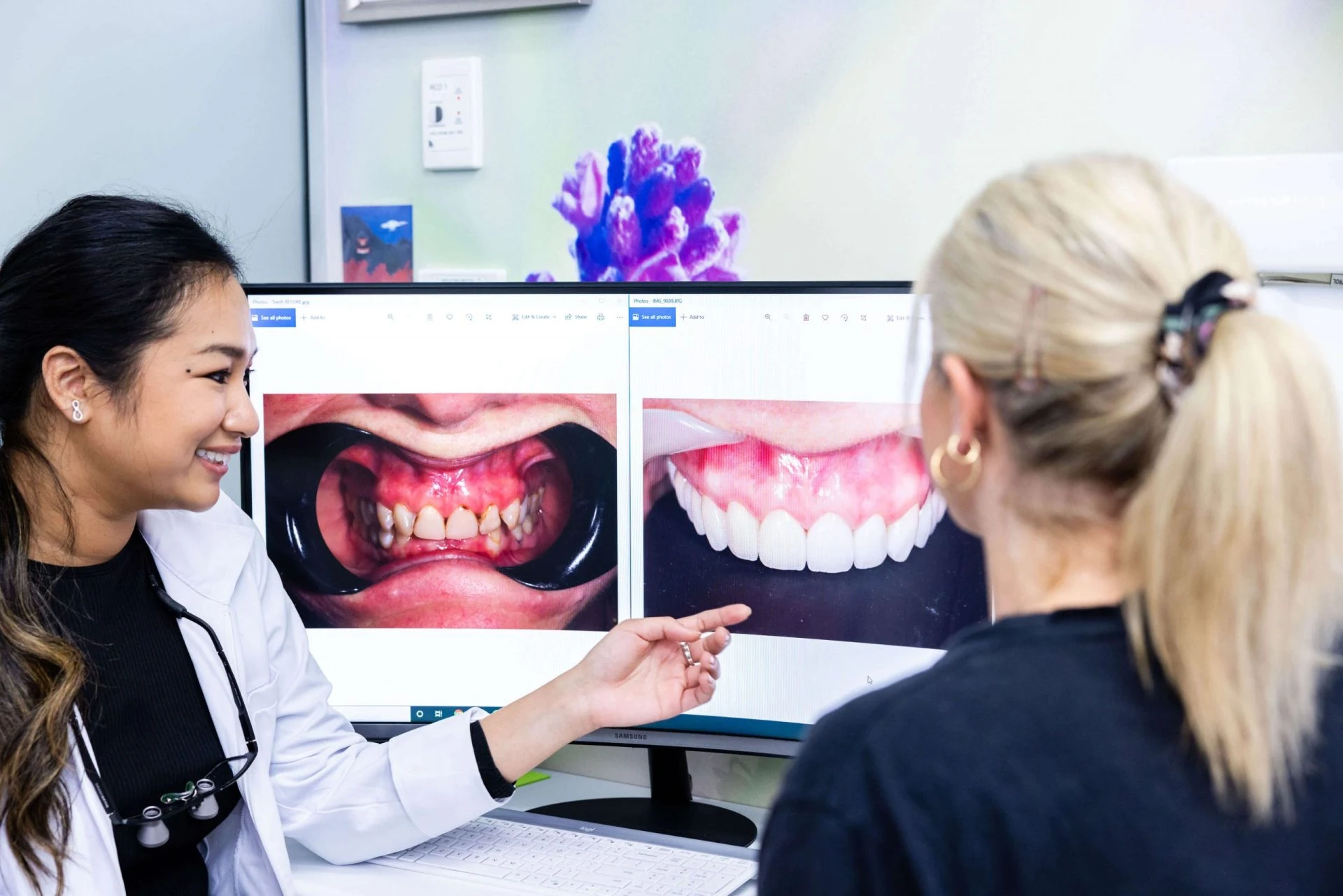 Will My Dental Veneers Fall Off? Will-My-Dental-Veneers-Fall-Off-Melton-Dental-House-Group
