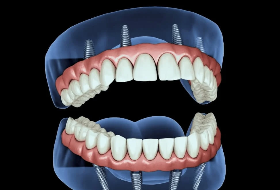 What Is All On 4 Plus® In Melton - Melton Dental House
