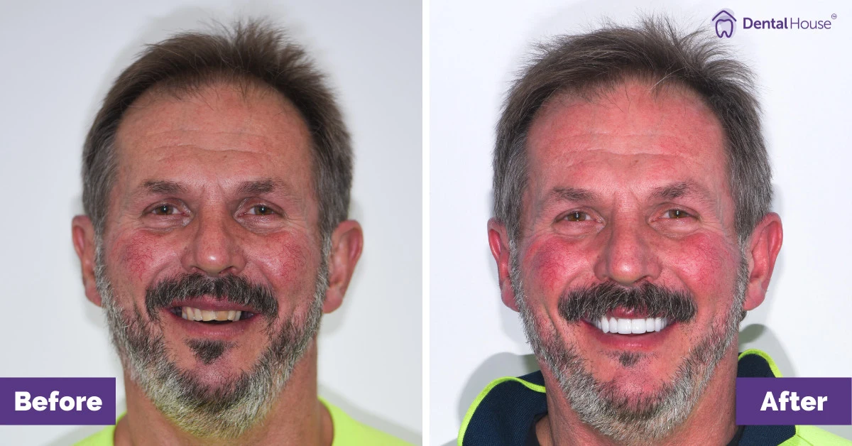 B’s Smile Makeover in Bacchus Marsh Gallery image