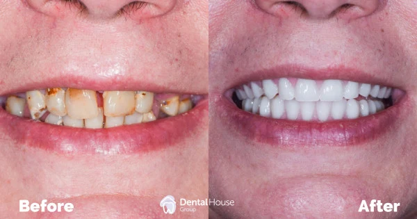 Complete Dentures Clinical Case in Bacchus Marsh Complete Dentures Clinical Case in Bacchus Marsh 1
