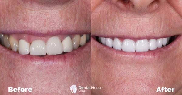 Crown & Veneer Replacement Clinical Case in Melbourne Crown Veneer Replacement Clinical Case in Melbourne 1