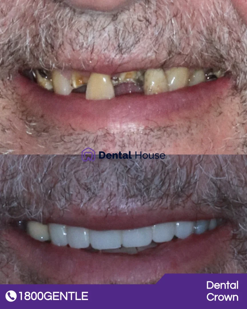 Dental Crown