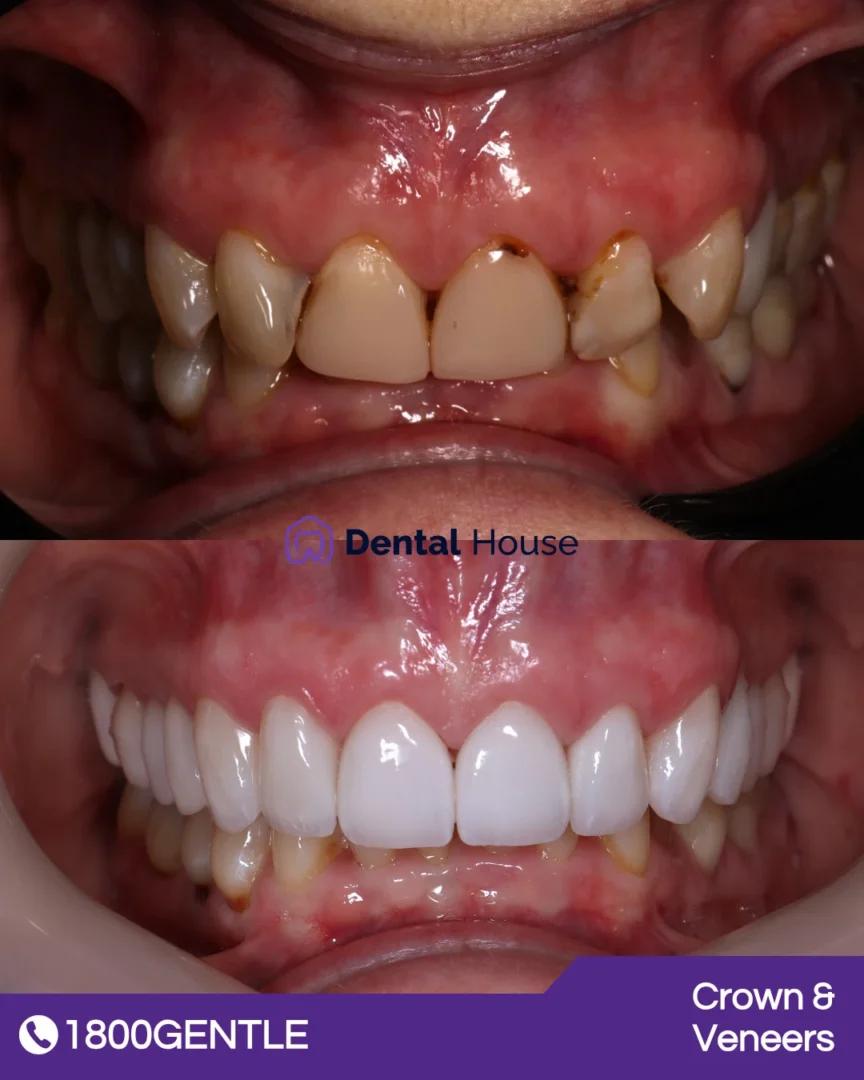 Dental Crown & Veneers