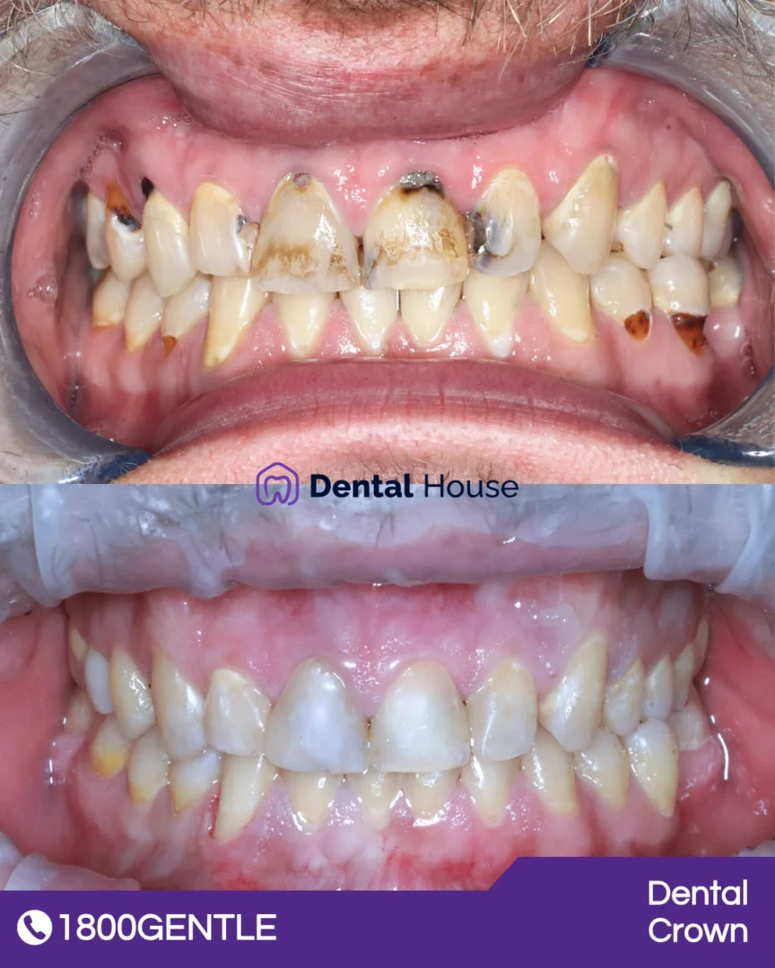 Dental Crowns