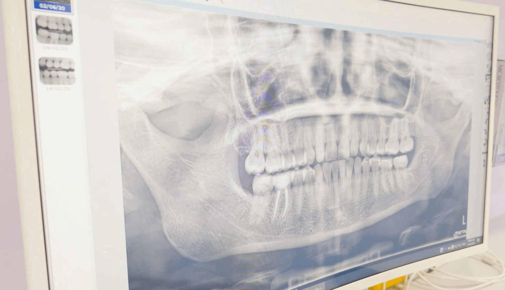 What Is The Cost Of Dental Implant? Dental House Group Dental Implant 1 1