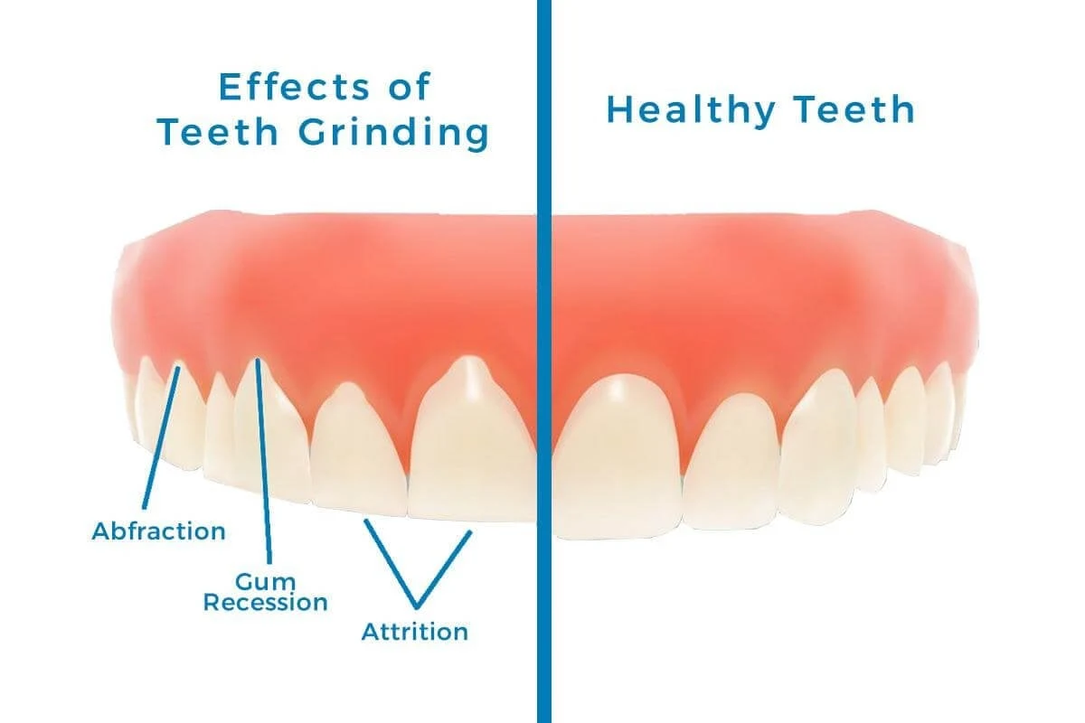 Dental House Prevent Teeth Grinding 1 300x200 1
