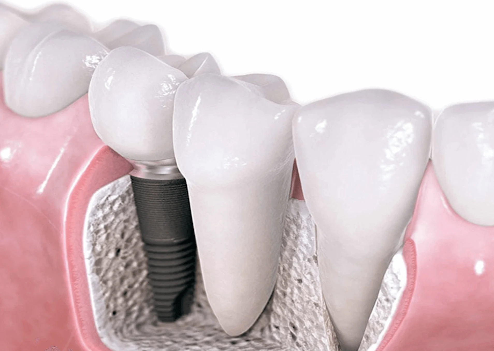 What Is The Cost Of Dental Implant? Dental Implant Dental House 1