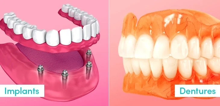 Dentures Vs. Dental Implants Dentures vs Dental Implants Sunbury