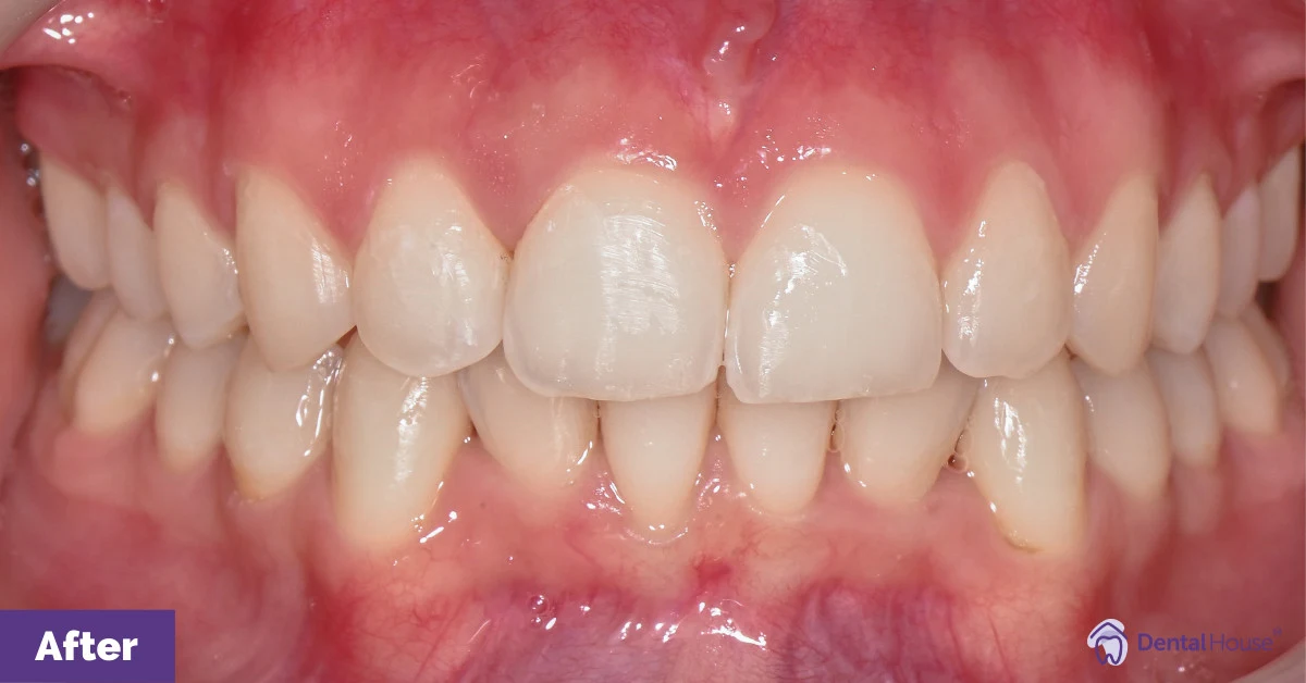 Eden’s Invisalign Smile Makeover in Bacchus Marsh Gallery image