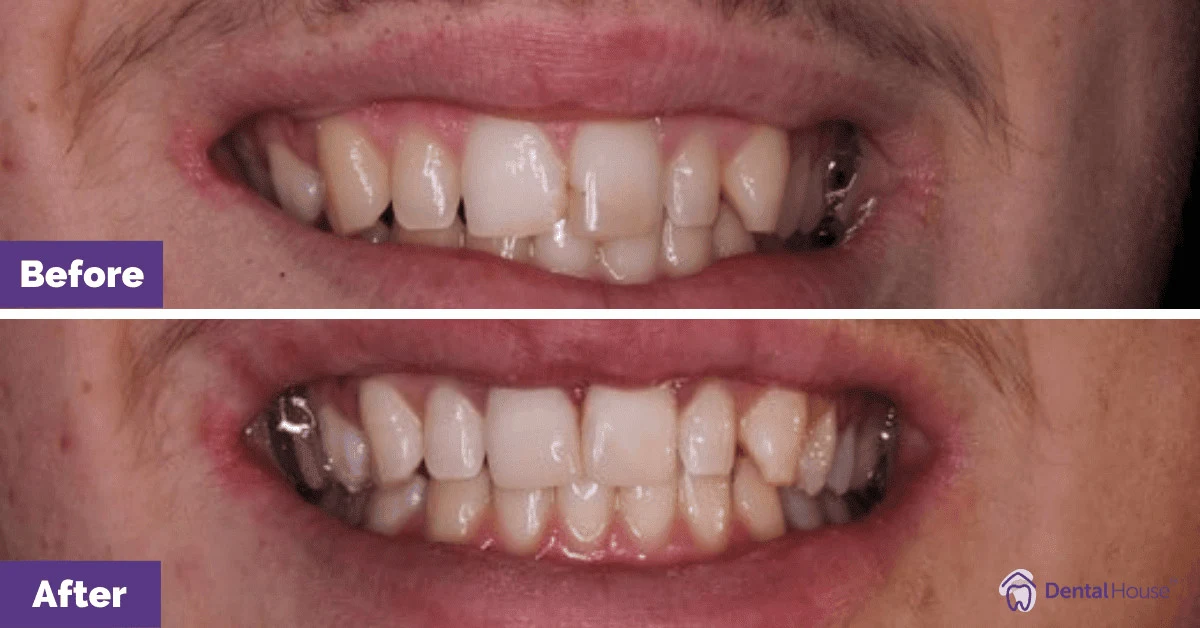 F’s Resin Filling Journey in Gisborne F-Resin-Fillings-in-New-Gisborne-2-1