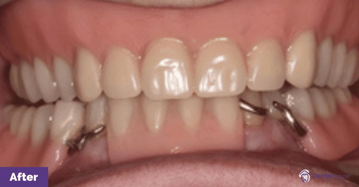 H’s Denture Journey in Melbourne Gallery image