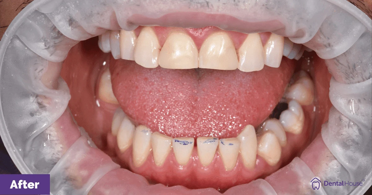 Ian’s Smile Makeover in Gisborne Gallery image
