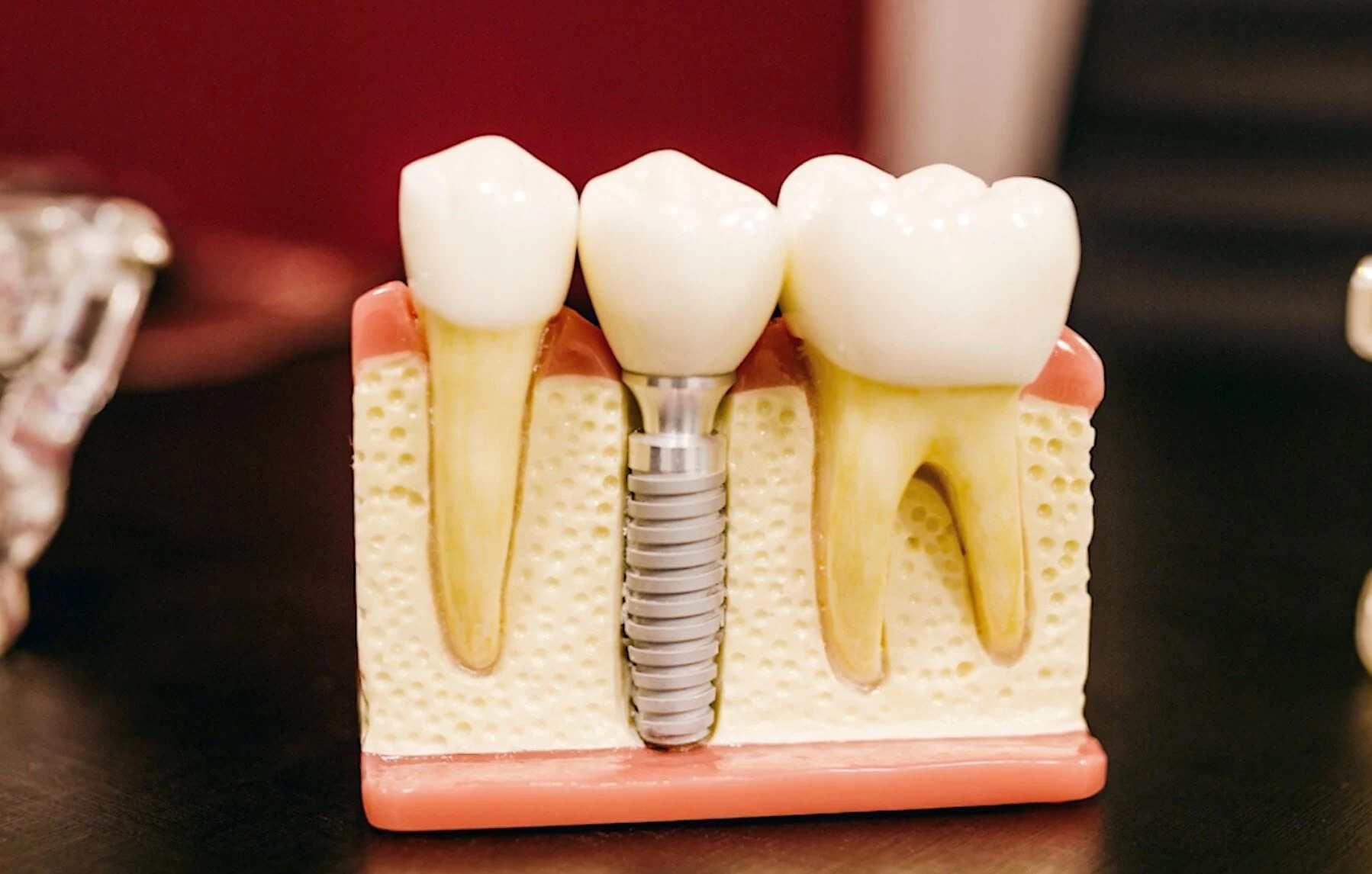 What Is The Process Of Dental Implant? Implant Melbourne Dental House Group 1