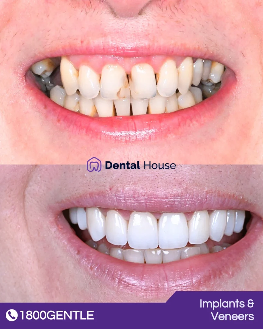Implants & Crown
