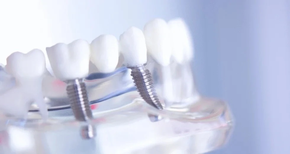 Inside Your All On 4 Plus®: The Titanium Frame and Components That Make It Work Inside Your All On 4 Plus® The Titanium Frame and Components That Make It Work in Melton Dental House