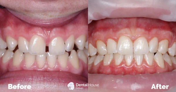 Invisalign Gap Closure Clinical Case in Melbourne Invisalign Gap Closure Clinical Case in Melbourne