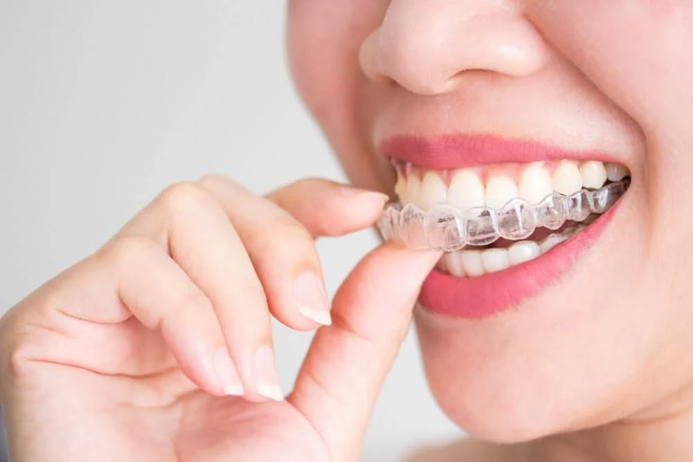 Invisalign and Its Effectiveness Bacchus Marsh 1