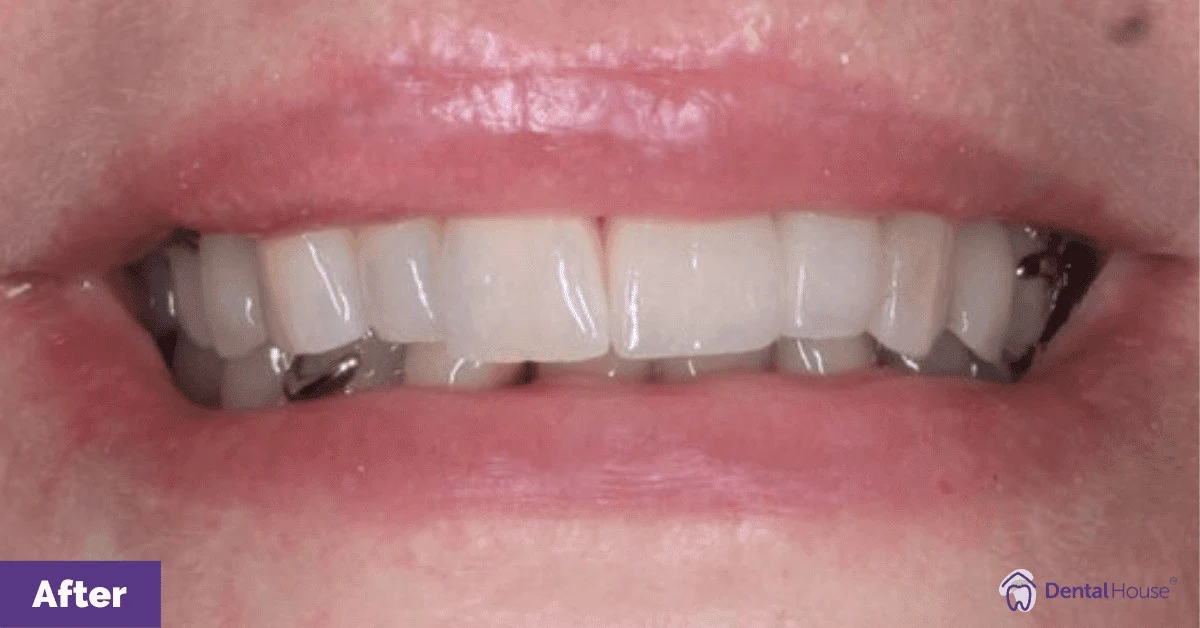 JB’s Porcelain Crowns in Gisborne Gallery image