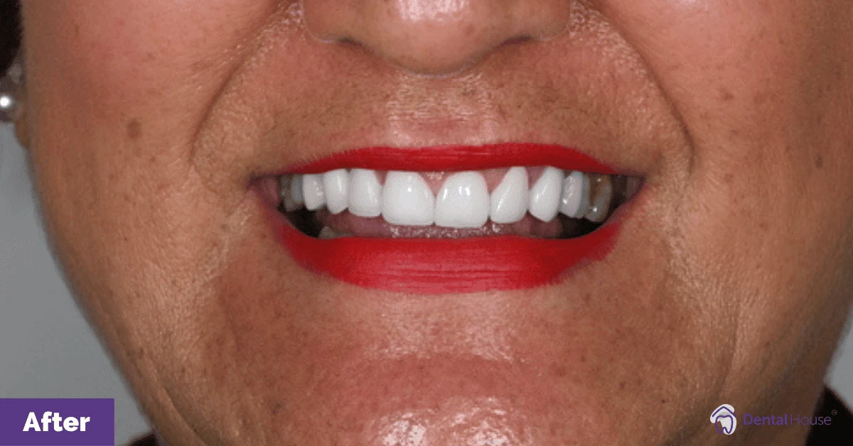Joanna’s Smile Makeover in Bacchus Marsh Gallery image