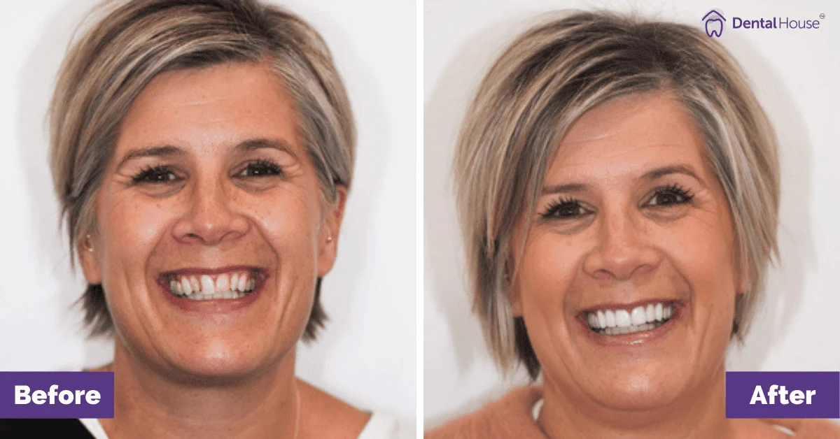 Kate’s Smile Makeover in Bacchus Marsh Gallery image