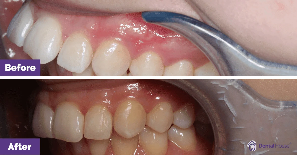L’s Invisalign Smile Makeover in Bacchus Marsh Gallery image