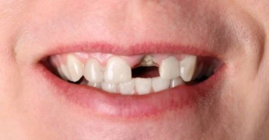 Can “Long Covid” Cause Your Teeth To Fall Out? MissingTooth2