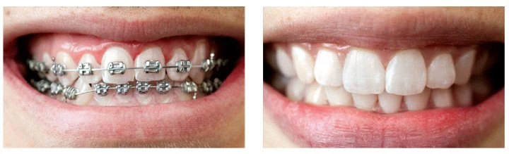 Oral Care During Orthodontic Treatment Oral Care During Orthodontic Treatment1 1