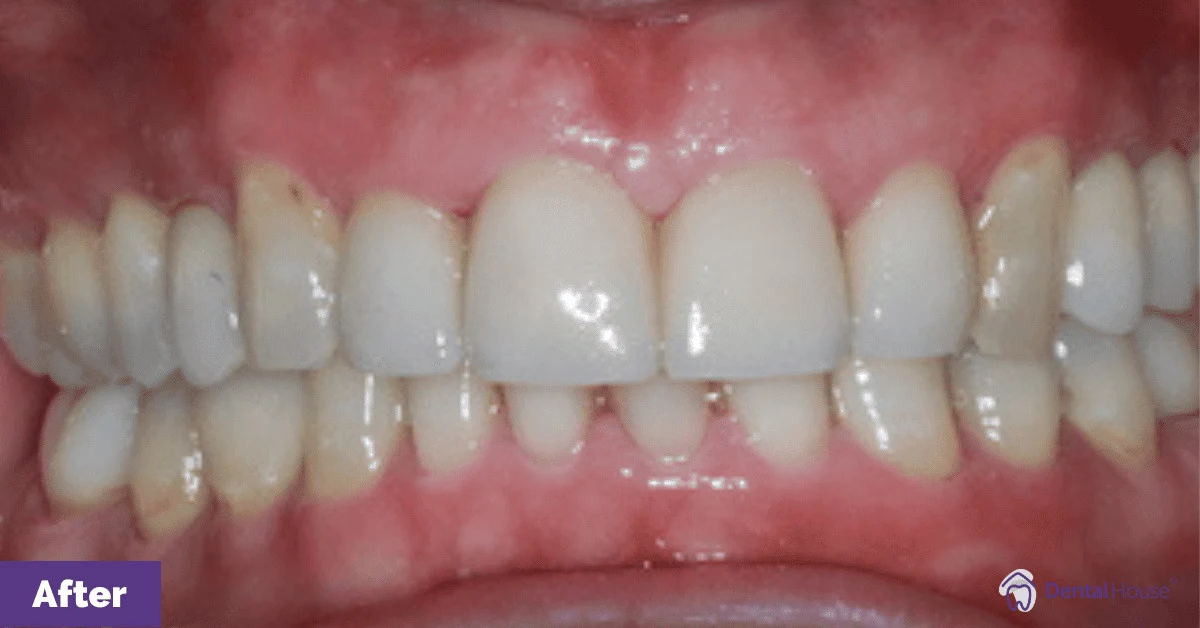 Oscar’s Porcelain Crown & Veneers in Gisborne Gallery image