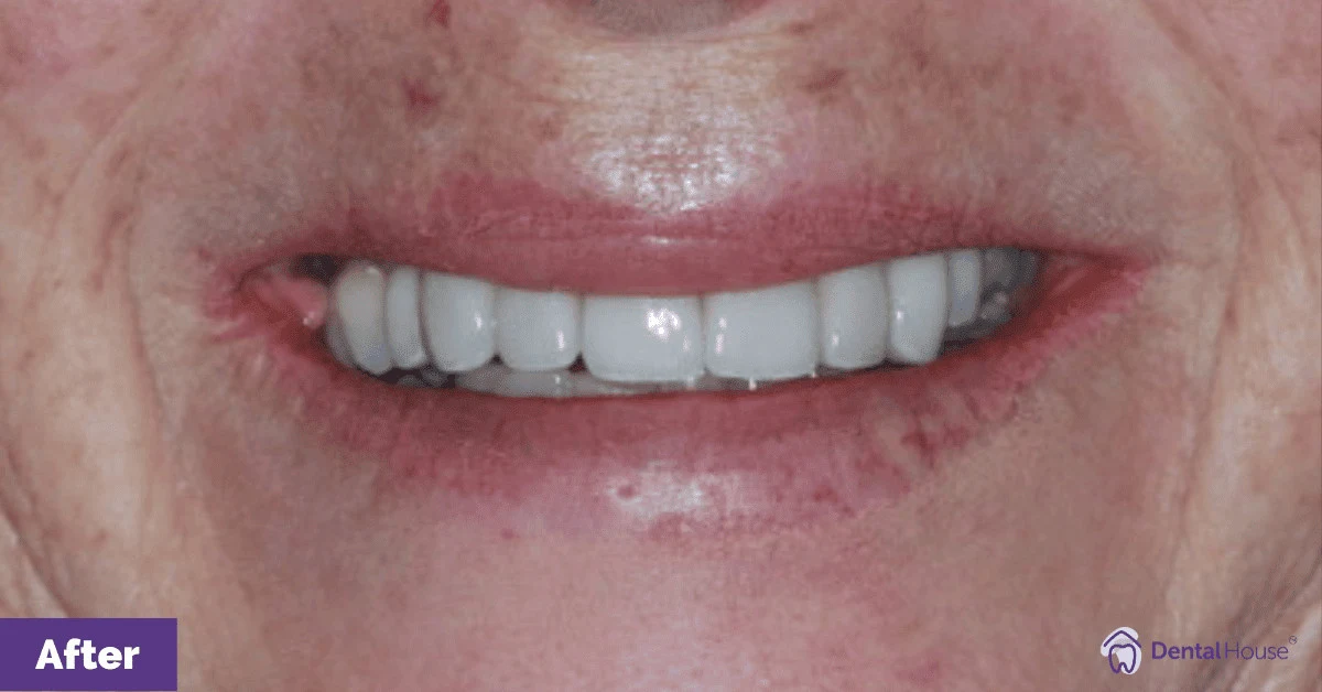 SS’s Porcelain Veneers & Whitening in New Gisborne Gallery image