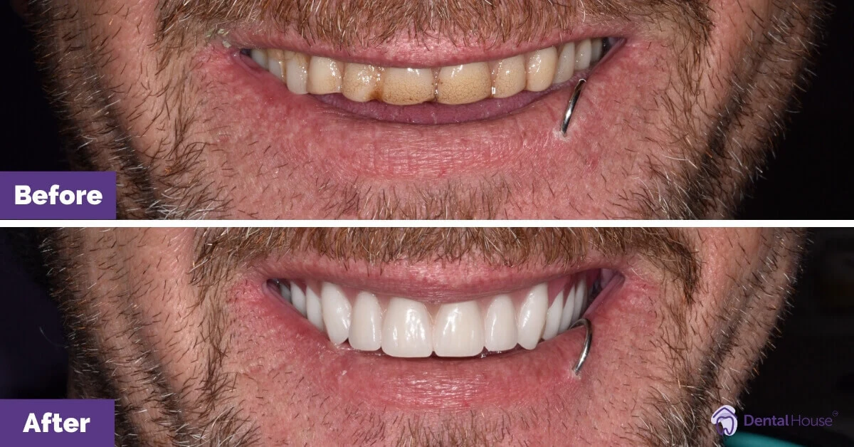 Shayne’s Denture Journey in Melbourne Gallery image