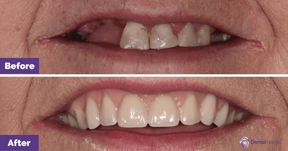 Sue’s Denture Journey in Melbourne Gallery image