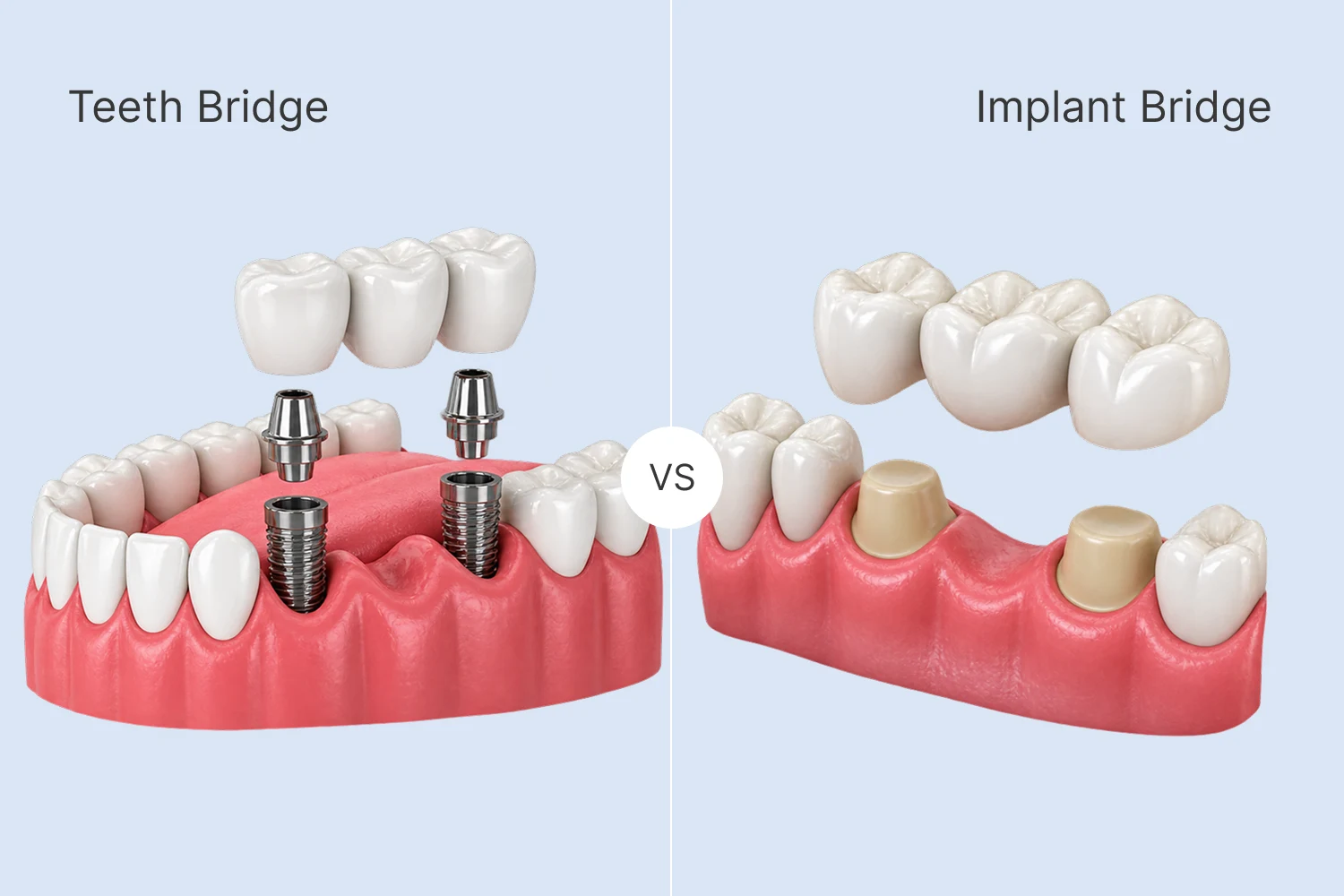 Teeth Bridge Price vs Implant Bridge