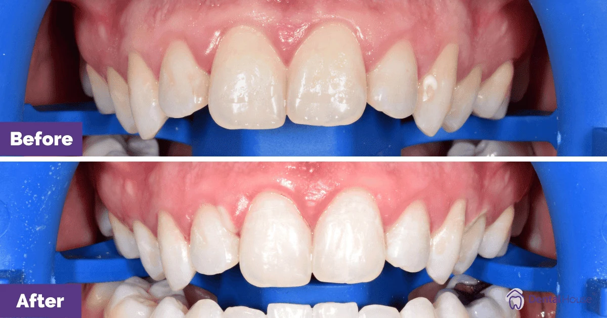 V’s Zoom Whitening Treatment in Melbourne Gallery image