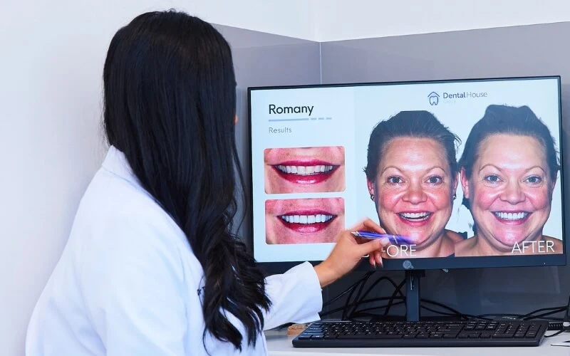 Am I a Candidate for No-Prep Veneers? Am I a Candidate for No-Prep Veneers? In Melton Dental House