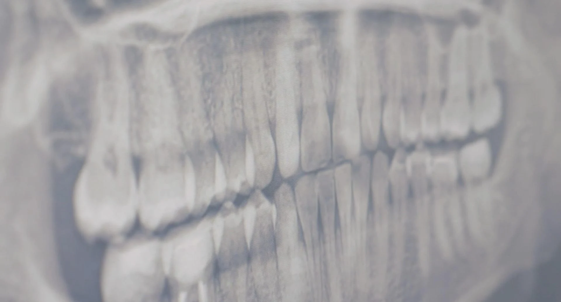 What Happens To Impacted Wisdom Teeth When Left Untreated? Wisdom Tooth Melbourne Dental House Group 1